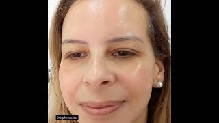 Tratamento para Melasma dragifernandes [upl. by Aihseuqal]