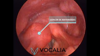 CÁNCER DE ARITENOIDES  ARYTENOID CANCER  CIRUGÍA LASER  LASER SURGERY [upl. by Gannes]