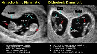 Fetal Twins Ultrasound Normal Vs Abnormal  MonochorionicDichorionicDiamnioticMonoamniotic USG [upl. by Aleahpar234]