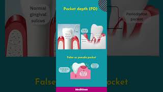 Gingival recession Pocket and clinical attachment loss [upl. by Asiaj]