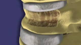 Balloon Kyphoplasty for Vertebral Compression Fractures Procedure [upl. by Eveneg]