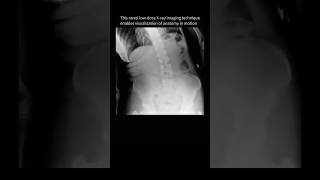 Spine movement seen for the FIRSTTIME with dynamic XRay backpain anatomy [upl. by Alisia]