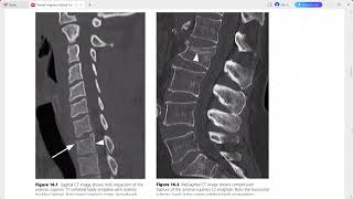 CLINICAL IMAGING OF SPINAL TRAUMA [upl. by Old]