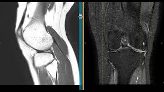 Mucoid degeneration of the lateral meniscus [upl. by Rossuck]