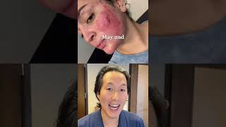 Incredible Cystic Acne Before and After shorts acne [upl. by Raquel]