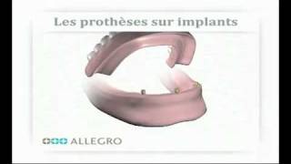 Implants dentaires  Déroulement des traitements [upl. by Tsirc]