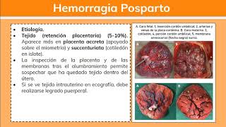 Hemorragia Posparto 12  Ginecología [upl. by Polloch677]