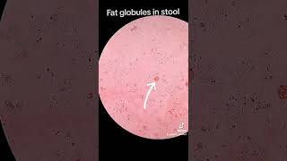 Fat globules in stool [upl. by Shelia304]