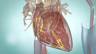 Premature Ventricular contraction PVCs [upl. by Painter]