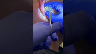 A satisfying earwax removal with microscope and forceps earwaxremoval extractionsatisfaction [upl. by Areemas]