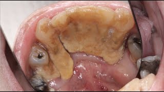 MASSIVE Calculus Buildup  Severe Gum Disease Case [upl. by Moriah110]