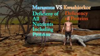 Marasmus Difference Between Marasmus Cachexia and Kwashiorkor [upl. by Aikam969]