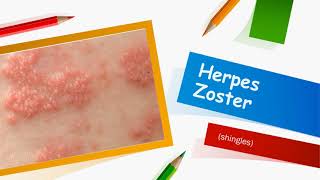 Herpes Zoster [upl. by Klecka]