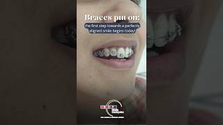 Braces Transformation in just 1 month Watch now braces teeth teethbraces [upl. by Randene]