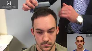 Hair Transplant Results  3464 FUT Grafts  6 months only The Maitland Clinic [upl. by Rebeh]