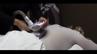 Dr Milan Shah explains what Endermologie is and what it does [upl. by Cousins401]