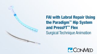 FAI and Labral Repair Using the Paradigm™ Hip System and PressFT™ Flex Anchor  CONMED Animation [upl. by Gellman]