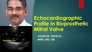 Echocardiographic profile of bioprosthetic mitral valve [upl. by Card]