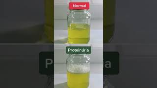 Normal Urine Vs Proteinuria Protein in Urine Differences [upl. by Niram330]