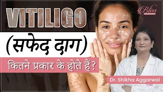 Vitiligo Skin Disease  Vitiligo Treatment  Types of Vitiligo  Skin Specialist in Ludhiana [upl. by Krug49]