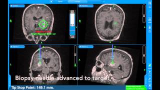 Insular high grade gliomastereotactic biopsy [upl. by Annodal197]