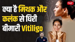 Vitiligo Skin Disease  Myths Stigma and Facts About This Skin Condition  UPSC [upl. by Derward]