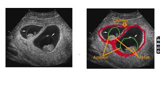 Anatomy of monochorionic diamniotic twin pregnancy twin anatomy pregnancy twinpregnancy [upl. by Mauldon]