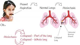 Atelectasis  signs and symptoms Mechanism of atelectasis explained simply [upl. by Naivart]