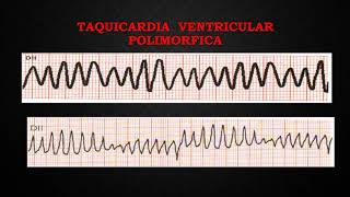 23 TAQUICARDIA VENTRICULAR [upl. by Muscolo182]