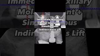 Immediate Maxillary Molar Implant with Simultaneous Indirect Sinus Lift [upl. by Assyral]