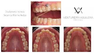 Distalamiento Secuencial Invisalign con Minitornillo Sequential Invisalign Distalization Miniscrew [upl. by Nanci946]