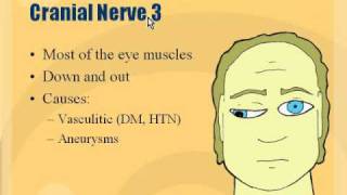 Neuro  Cranial Nerve 3 Palsy [upl. by Kela]