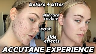 accutane experience  before amp after side effects cost skincare routine [upl. by Helbonia]