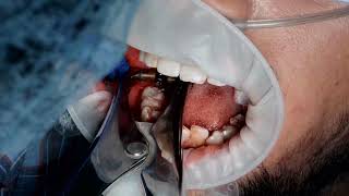 4647 norris implant  intraoral syncrystallisation by using 12 mm titanium wire [upl. by Adnic]