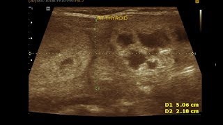 Ultrasound cases 312 of 2000  Multinodular adenomatous nodule Thyroid [upl. by Shreeves]