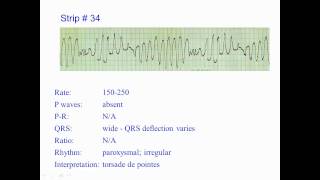 ECG Exercise 34 [upl. by Yeldnarb]