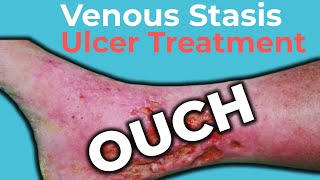 Venous Stasis Ulcer Treatment  Wound Care OC [upl. by Silas815]