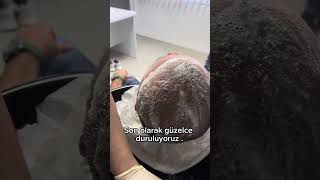 Saç ekimi 12 Gün kabuk dökümü işlemiEstecreative Hair Transplant [upl. by Ricky275]