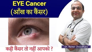 आँख के कैंसर को कैसे पहचाने  Eye Cancer  Symptoms of Eye Cancer  Best Treatment of Cancer [upl. by Jerz415]