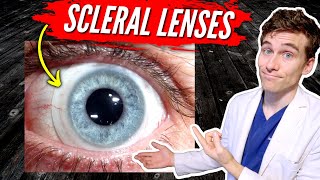 Scleral Lenses for Keratoconus 7 Facts You Need to Know [upl. by Tessie]