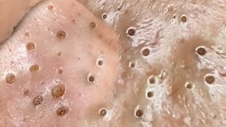 Deep Big Removal Of Blackheads Ear Nose [upl. by Tabatha]