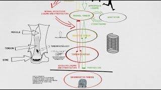 Tendinopathy Continuum and Update [upl. by Patty]