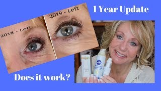 RetinA and Retinol Treatment for Deep Eye Wrinkles  Before and After [upl. by Moritz131]