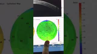 Keratoconus Careful evaluation of Pentacam and Optovue epithelialthickness maps Kanellopoulos MD [upl. by Sumerlin]