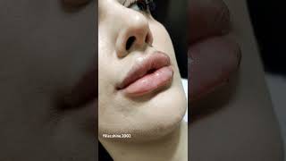 love lipfiller filler music lips [upl. by Chrisman589]