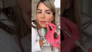 Injection for Downturned Mouth botox antiaging beauty fillers fillersinjection [upl. by Sekoorb450]