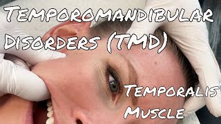 TMJ Pain  Temporalis Release  Motion Specific Release [upl. by Norej359]