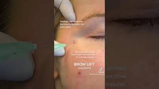 How to Safely amp Effectively Use Botox for Brow Lift [upl. by Aimahs]