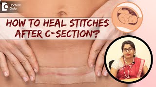 6 Tips to Take Care of Stitches amp Heal Fast After CSection DrSupritha Rangaswamy Doctors Circle [upl. by Posner]