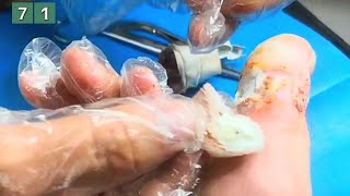 71Periungual wart on big toe [upl. by Hurwit]